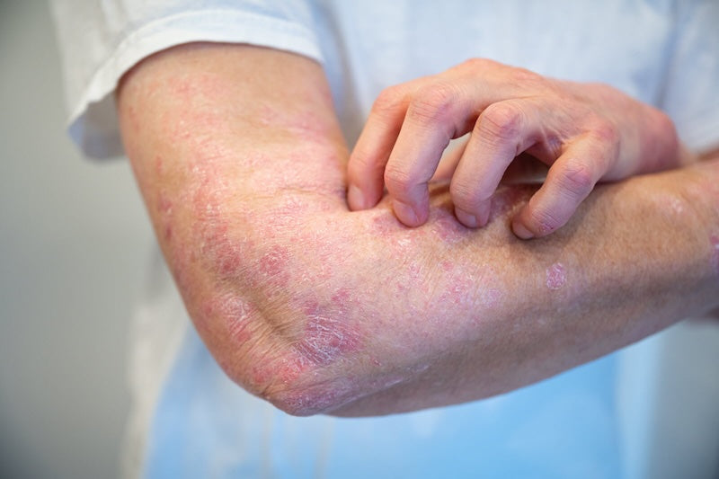 Quelles sont les causes du psoriasis ?
