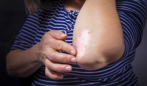 Où apparait le psoriasis ?