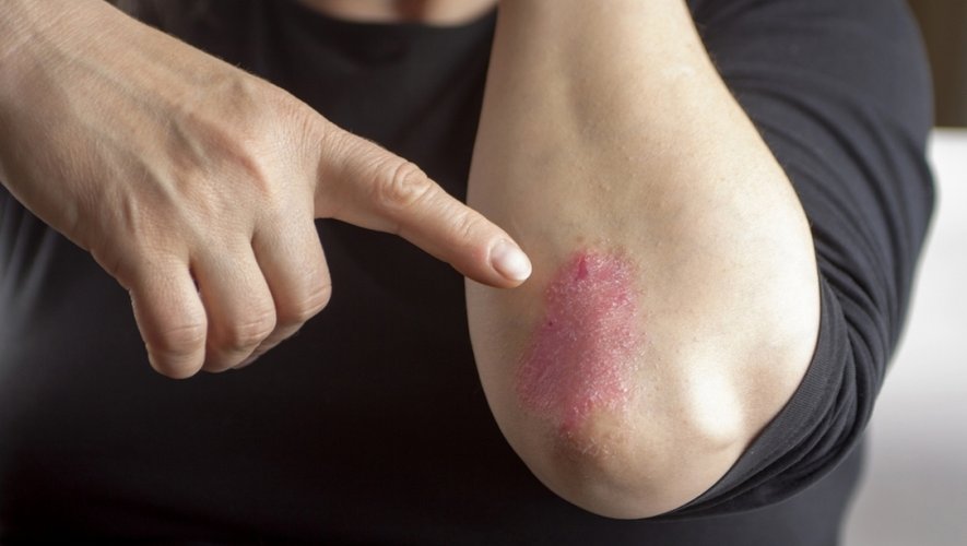 Psoriasis : symptômes, causes et traitements