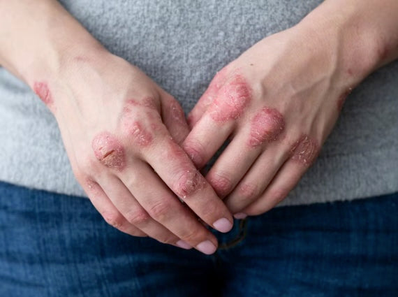 Qui est touché par le psoriasis ?