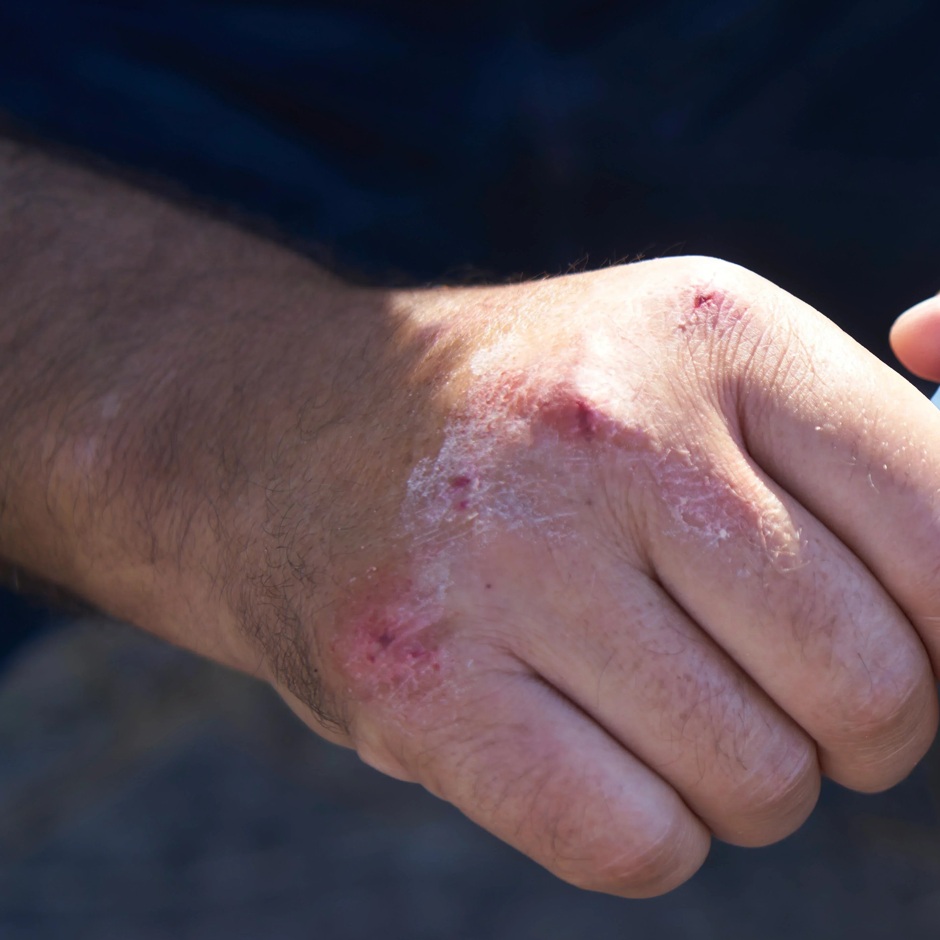 Reconnaitre psoriasis