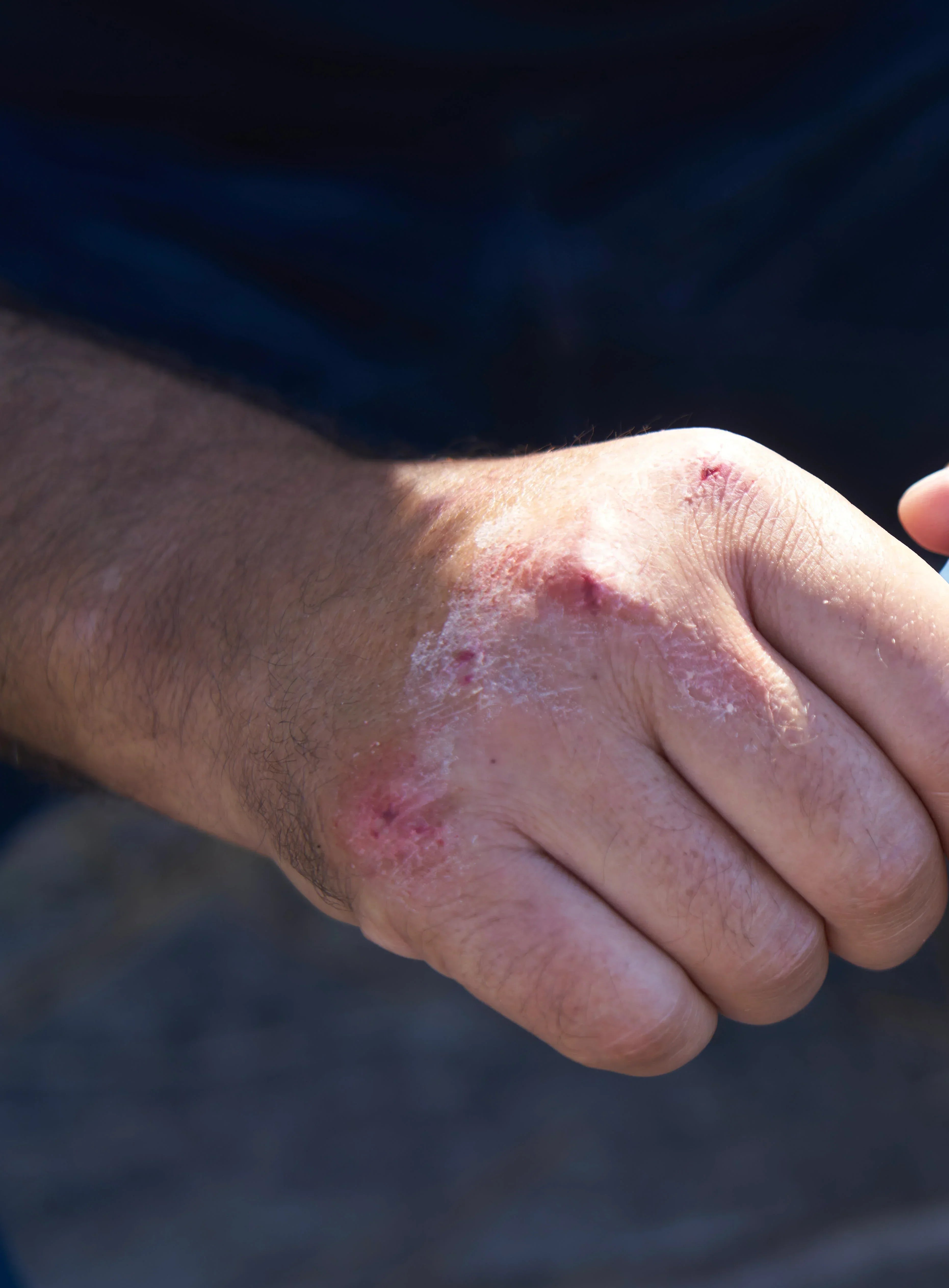 Reconnaitre psoriasis