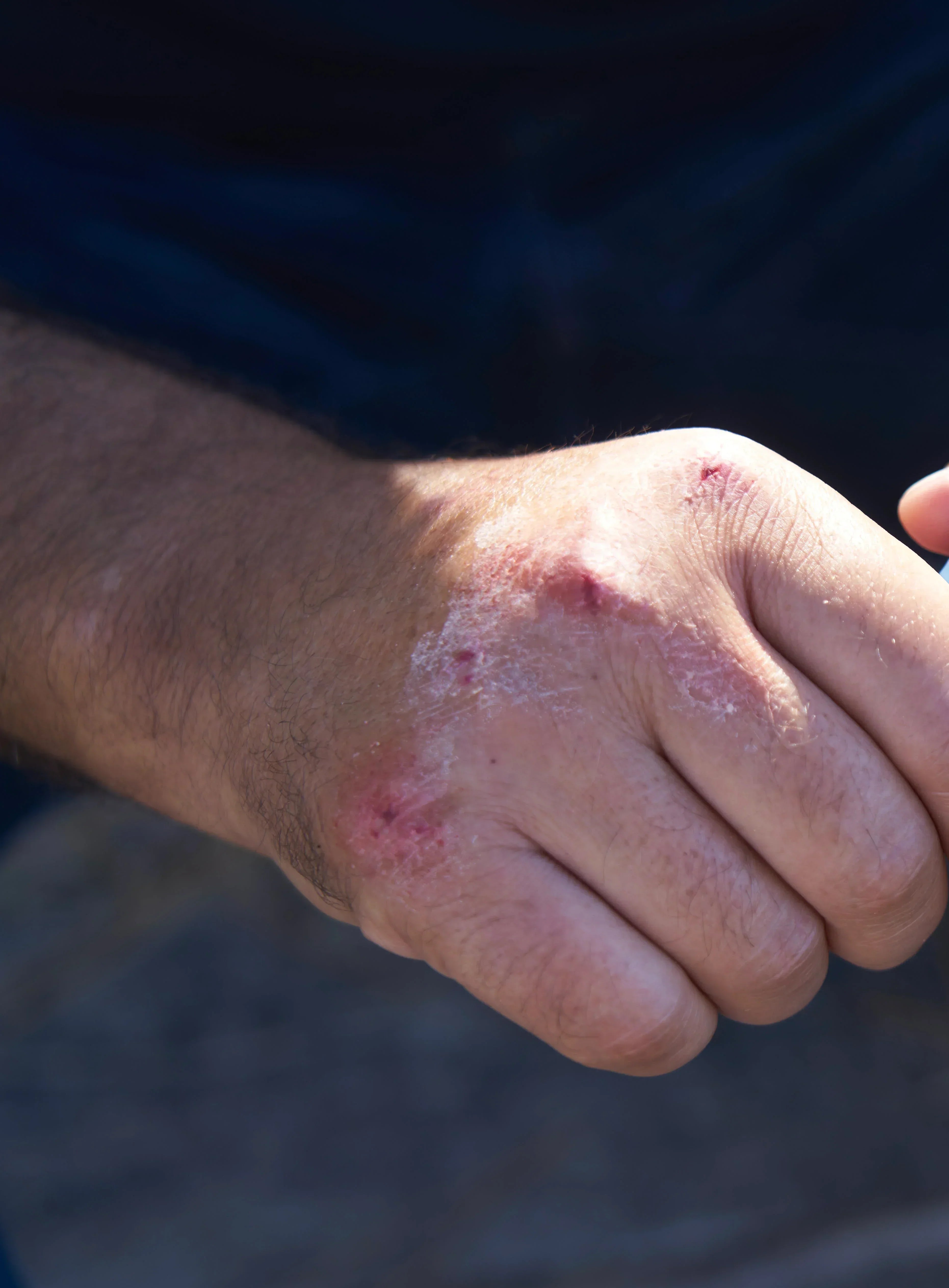 Comment reconnaître un psoriasis ?