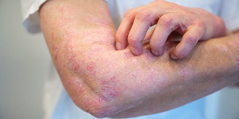Quelles sont les causes du psoriasis ?