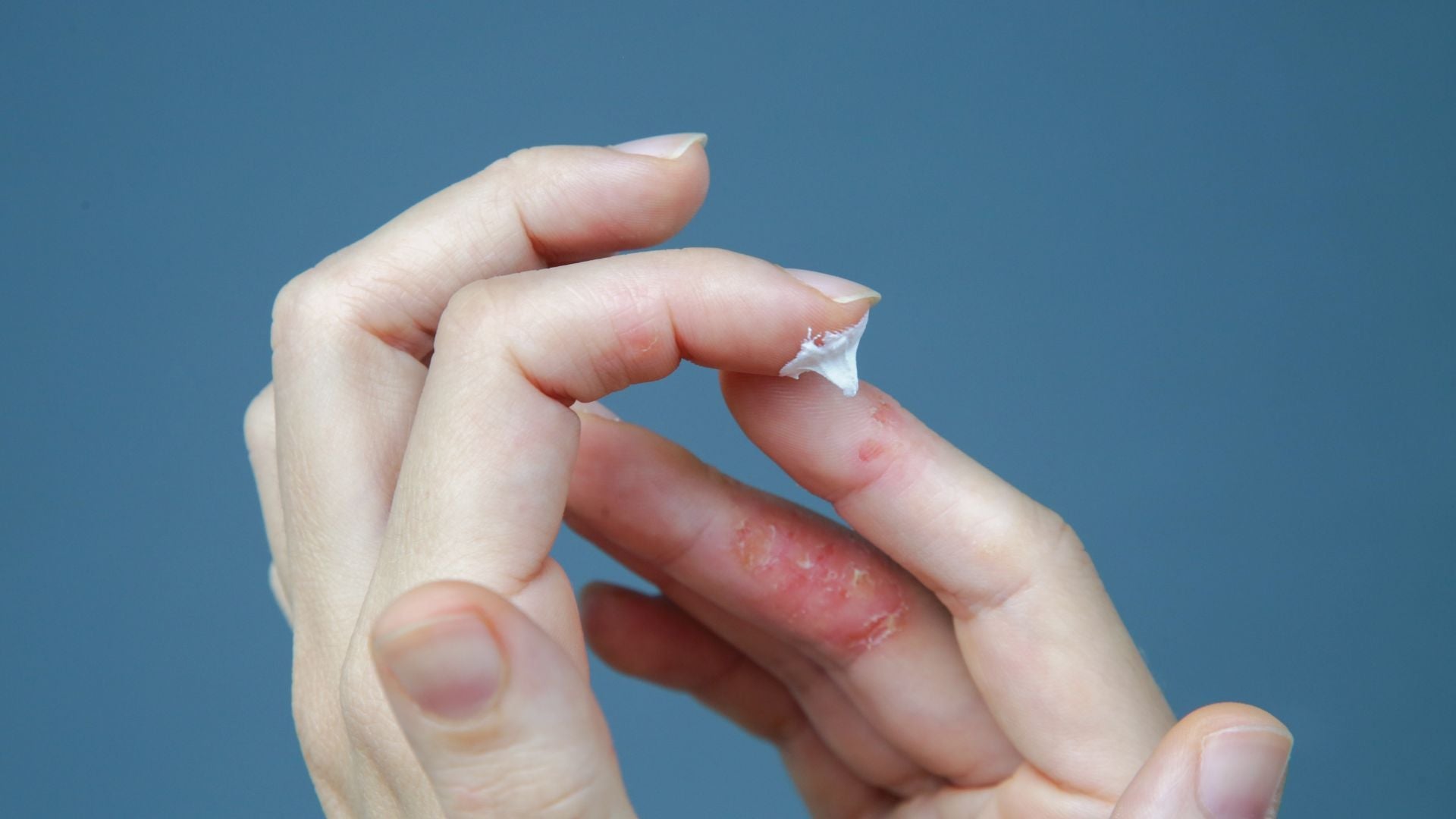 Comment choisir sa crème en cas de psoriasis ?