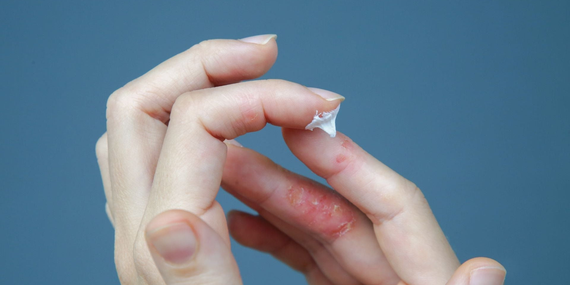 Comment choisir sa crème en cas de psoriasis ?