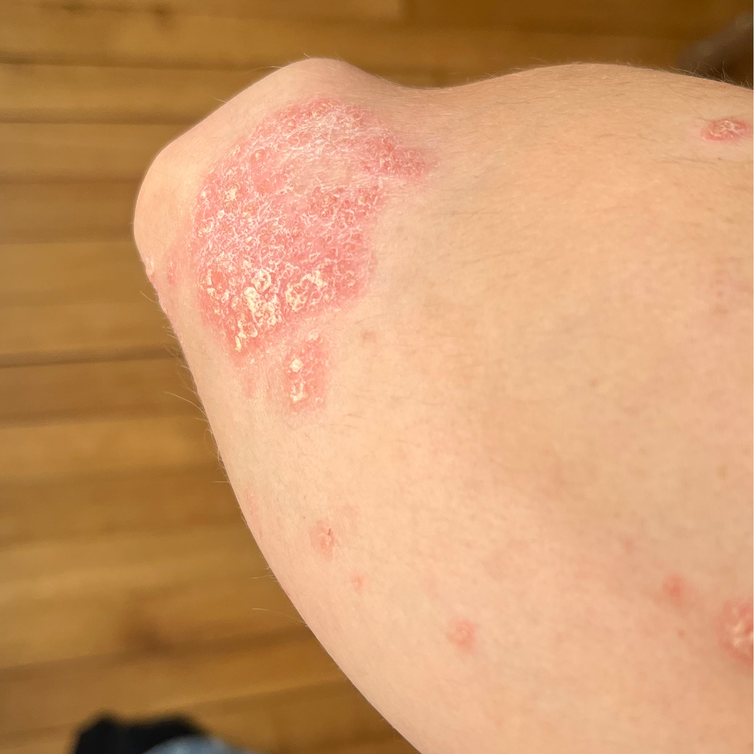 Quels sont les types de psoriasis ?