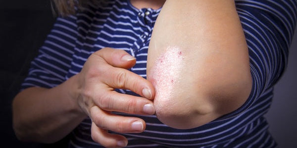 Où apparait le psoriasis ?