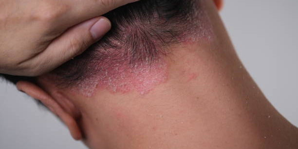 Psoriasis et stress : causes, symptômes, traitement et prévention