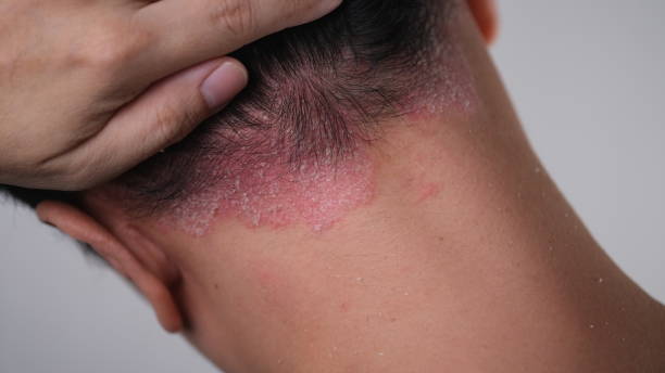 Psoriasis et stress : causes, symptômes, traitement et prévention Image