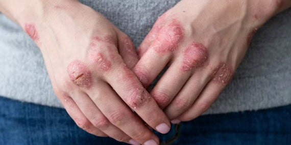 Qui est touché par le psoriasis ?