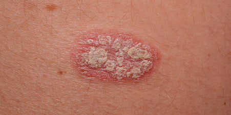 Quels sont les traitements naturels du psoriasis ?