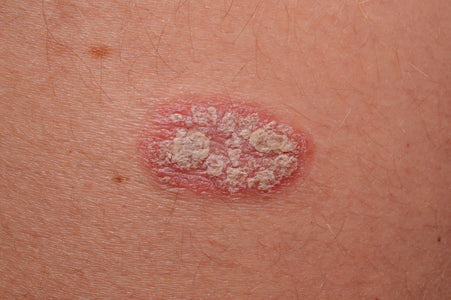 Quels sont les traitements naturels du psoriasis ?