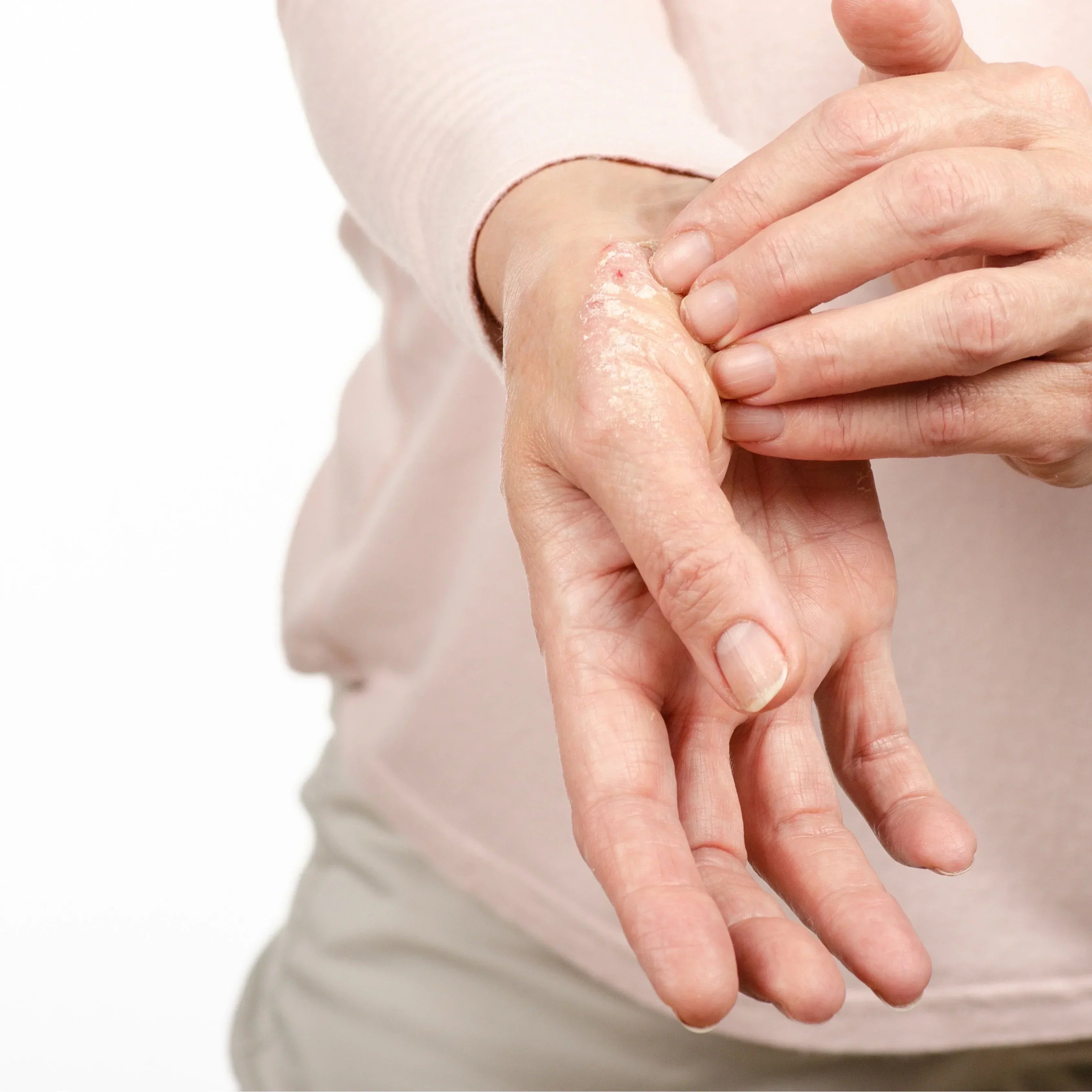 Psoriasis ou dermatite atopique ?