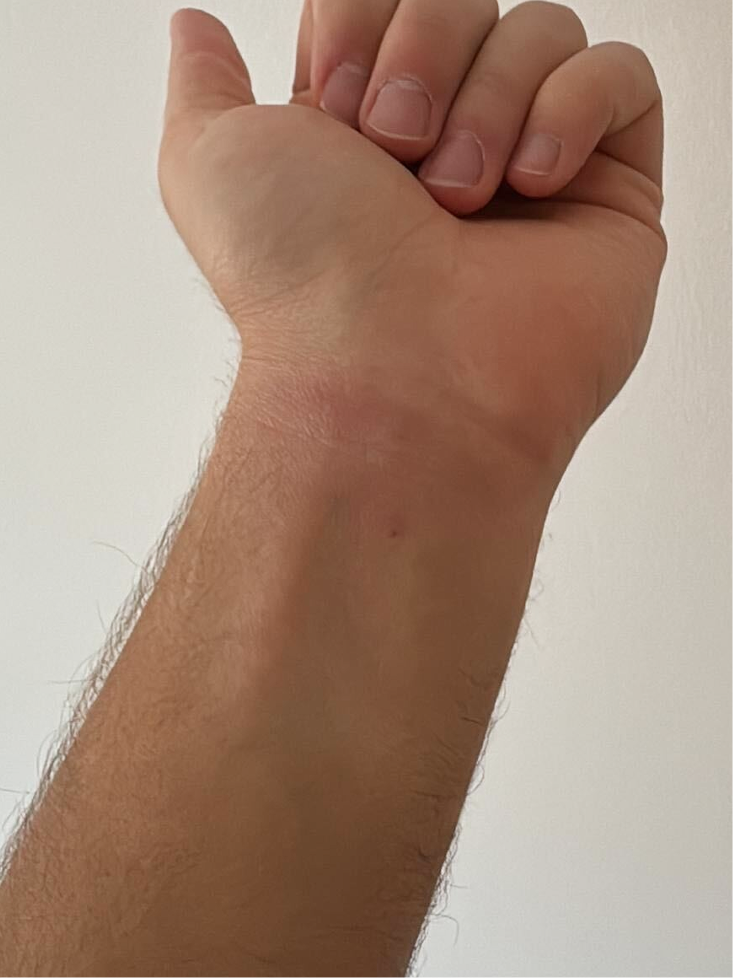 Amélioration de l’aspect du poignet après un soin apaisant, avec diminution des rougeurs et de l’inconfort cutané grâce à la crème de nacre de Blue Skincare