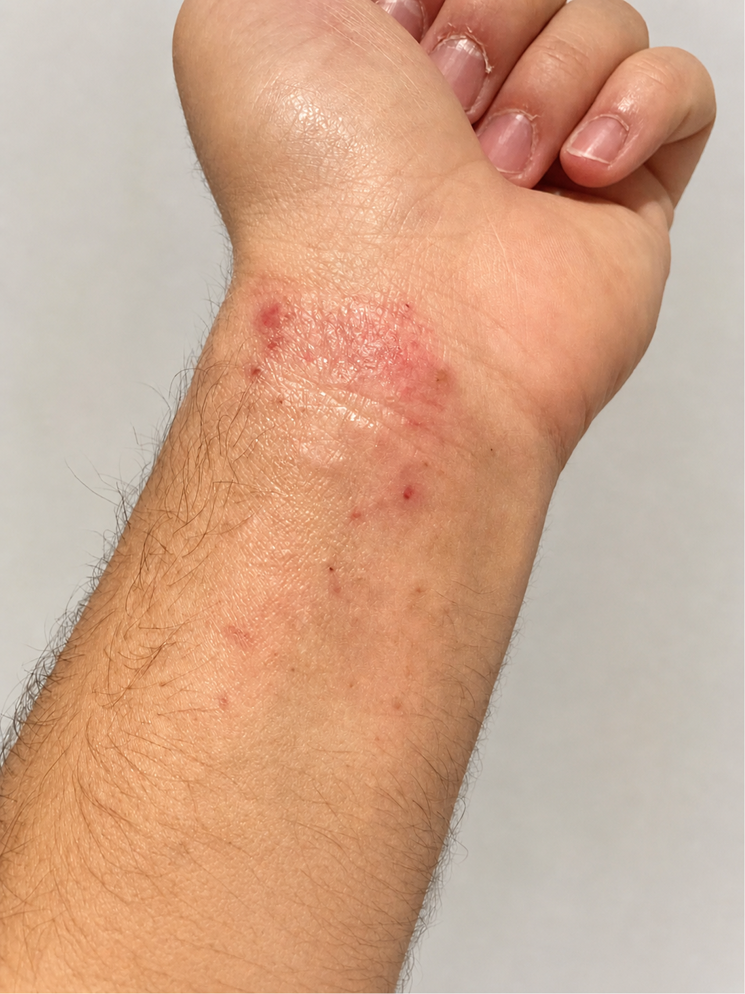 Poignet présentant des signes d’eczéma avec rougeurs, sécheresse et irritation cutanée.