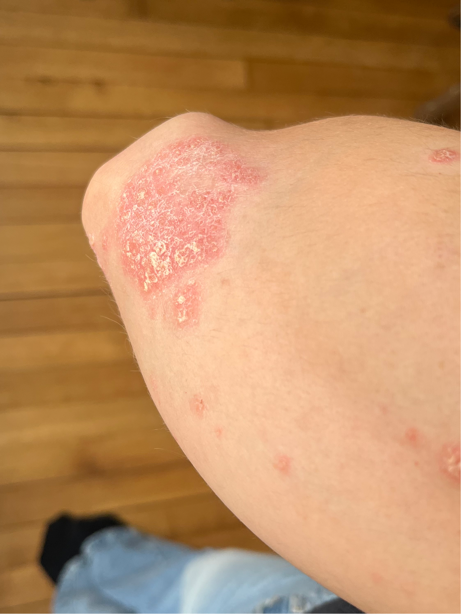 Aspect d’une plaque de psoriasis au niveau du coude avec rougeurs, sécheresse et irritation cutanée.