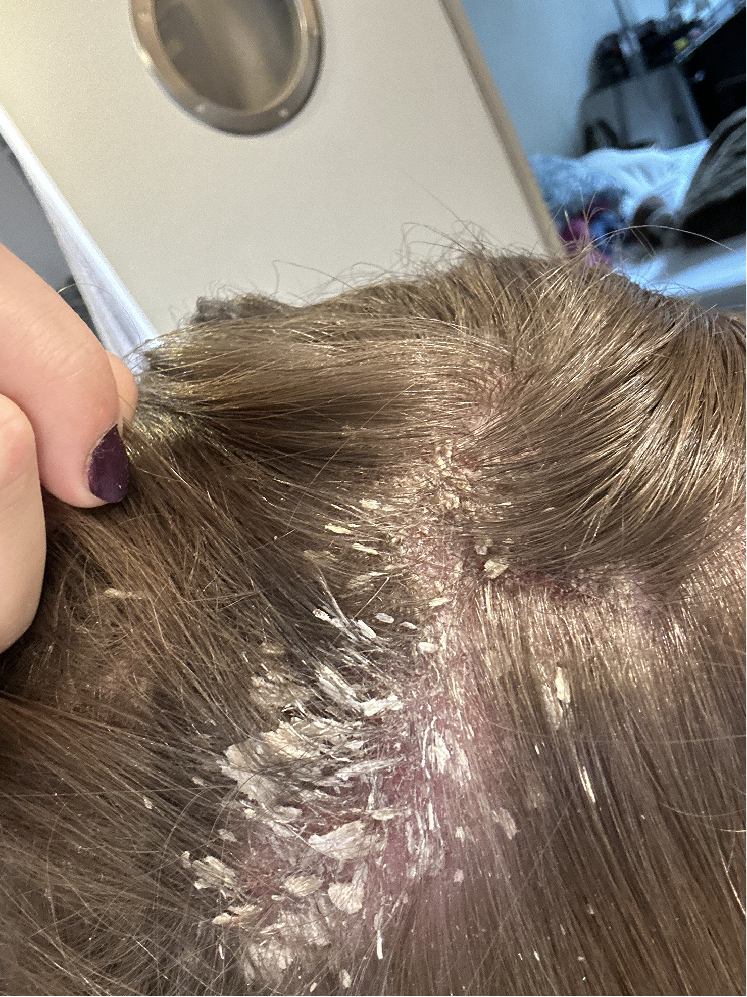 Cuir chevelu présentant des plaques de psoriasis avec squames épaisses et pellicules visibles.